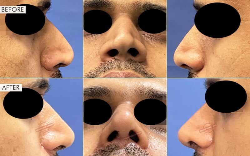 Rhinoplasty