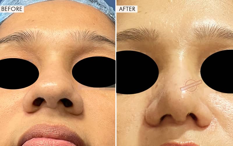 Rhinoplasty