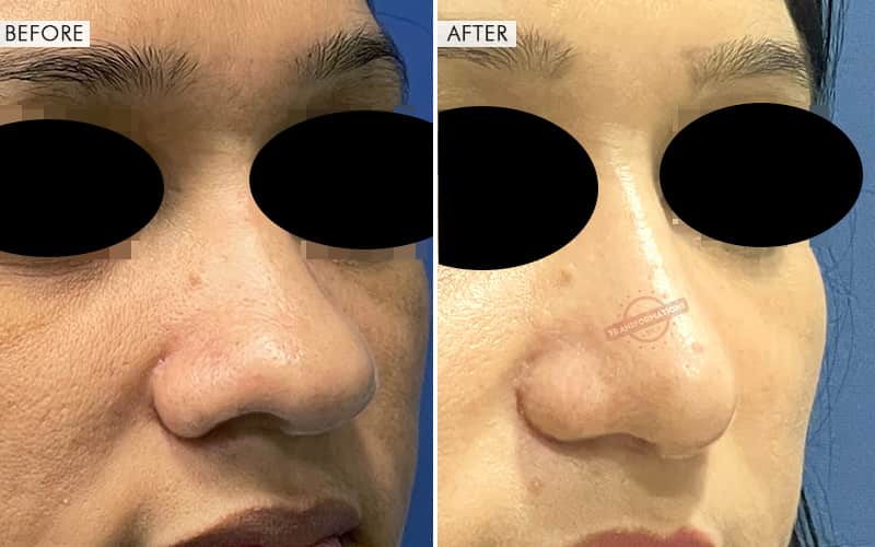 Rhinoplasty