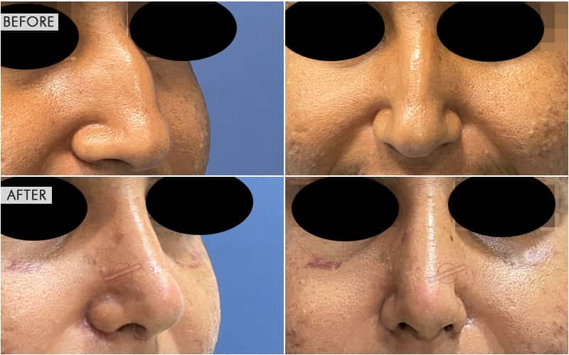 Rhinoplasty