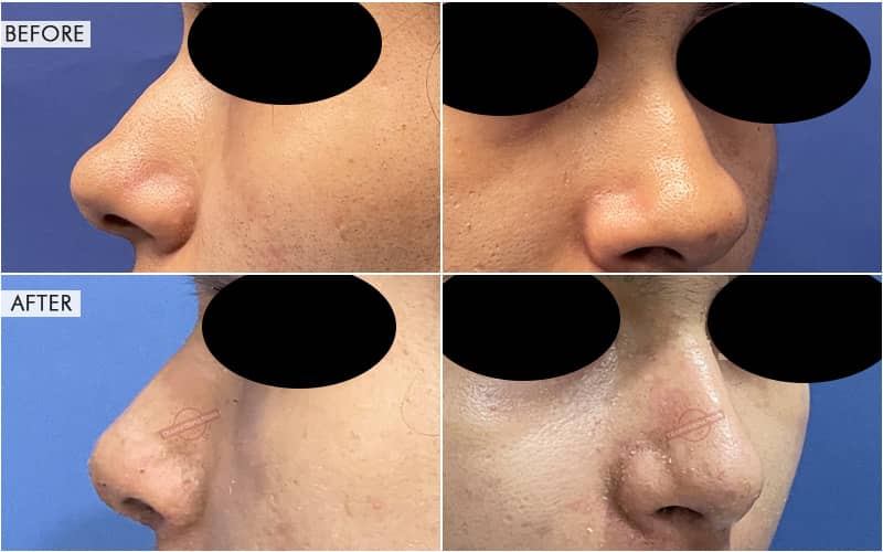 Rhinoplasty