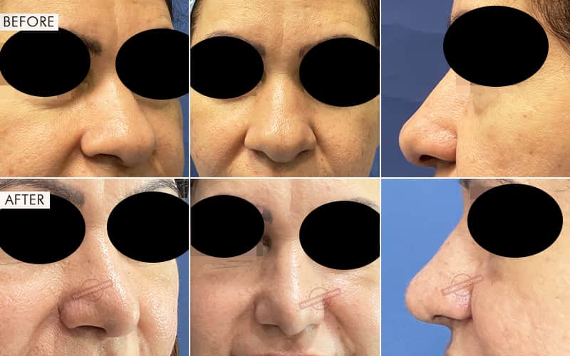 Rhinoplasty