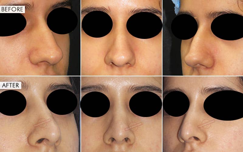 Rhinoplasty
