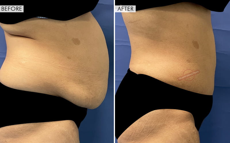 Tummy Tuck Surgery Before and After Results