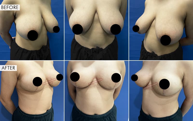 Breas-t Reduction surgery Before and After Results