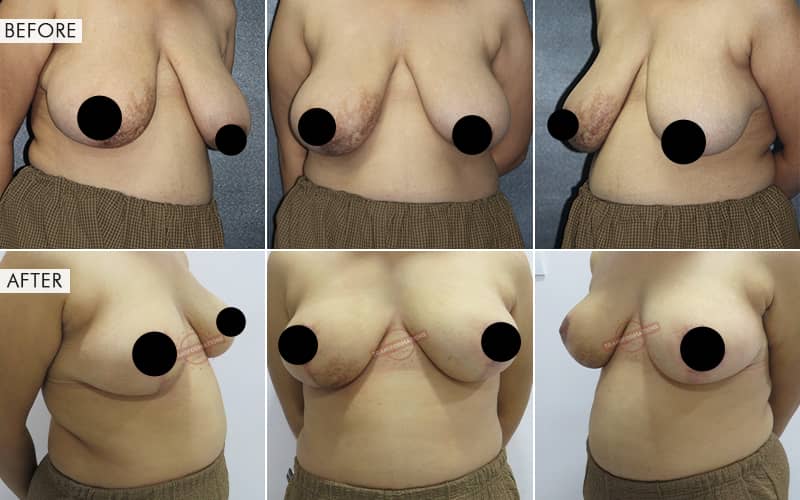 Breas-t Reduction surgery Before and After Results