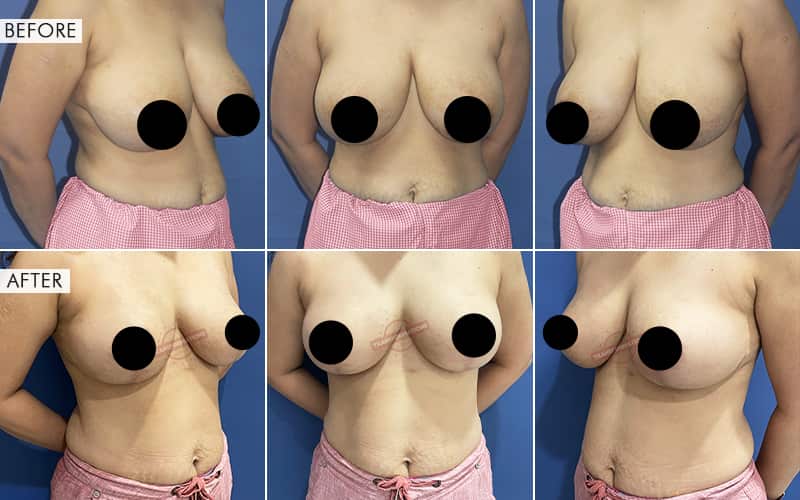 Breas-t Reduction surgery Before and After Results