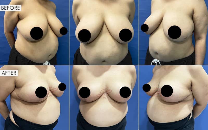 Breas-t Reduction surgery Before and After Results