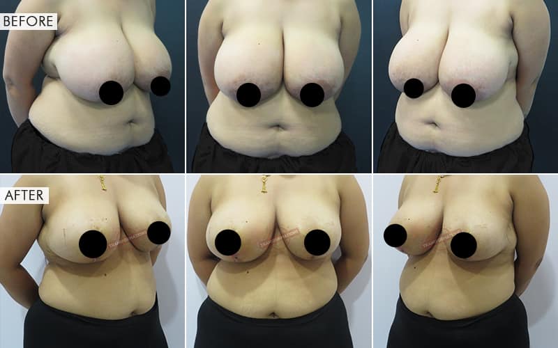 Breas-t Reduction surgery Before and After Results