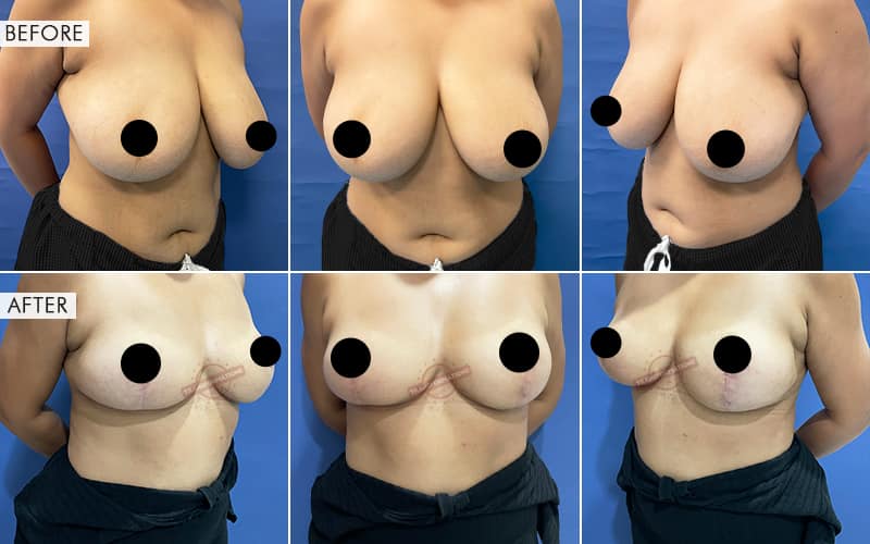 Breas-t Reduction surgery Before and After Results