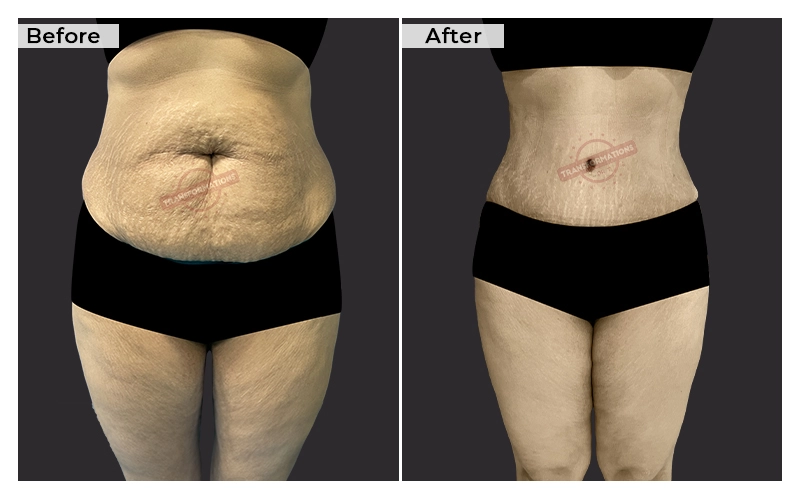 Tummy Tuck