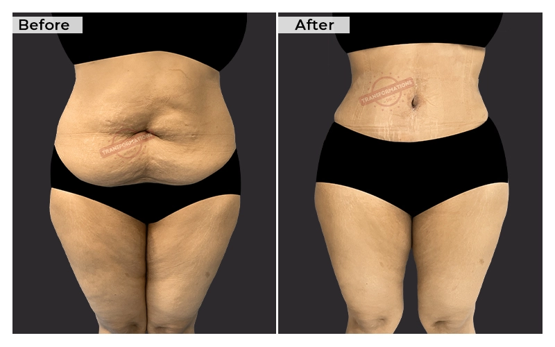 Tummy Tuck