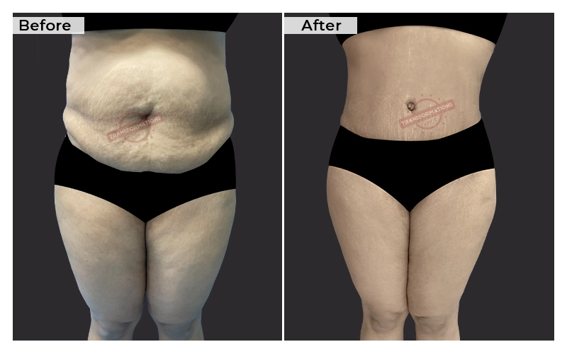 Tummy Tuck