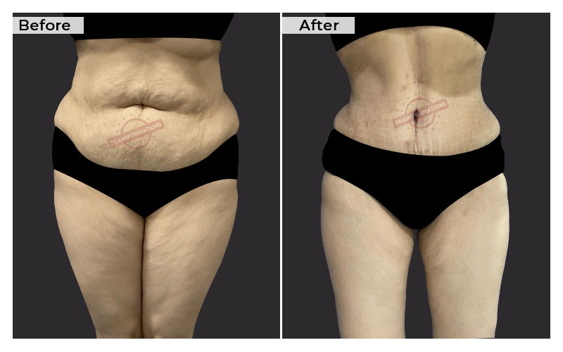 Tummy Tuck