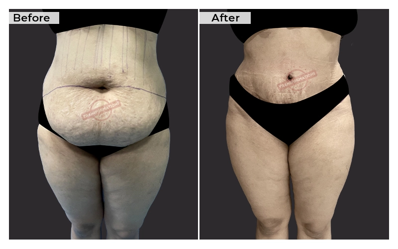 Tummy Tuck