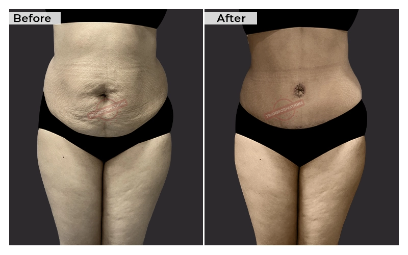 Tummy Tuck