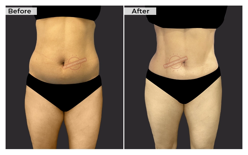 Liposuction