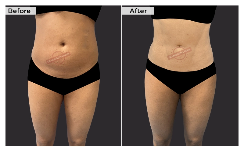 Liposuction