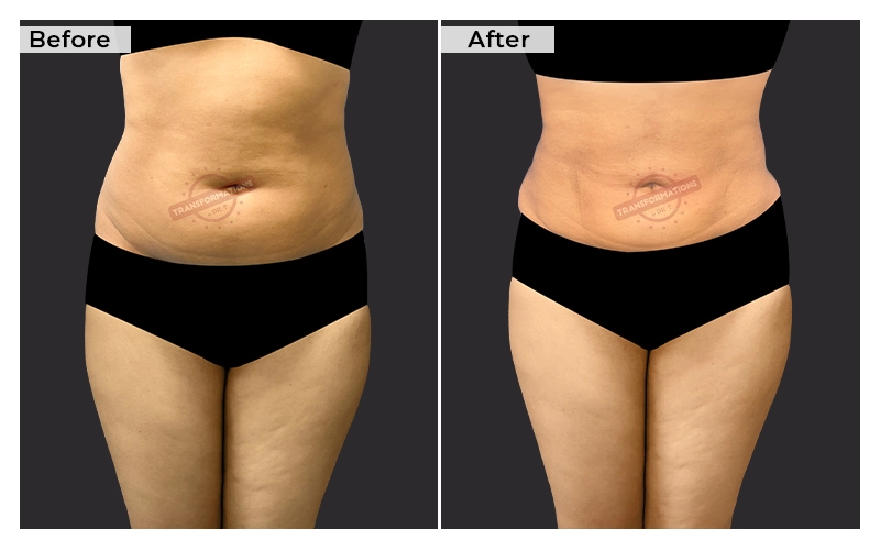 Liposuction