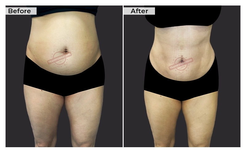 Liposuction