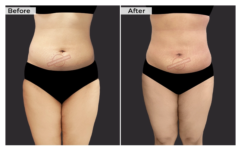 Liposuction