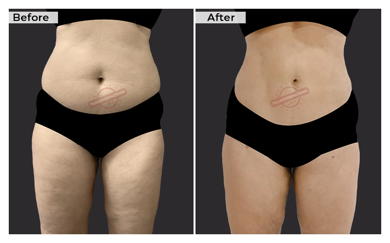 Liposuction