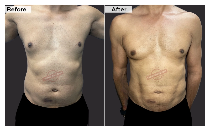 Liposuction