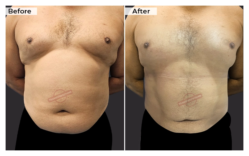 Liposuction