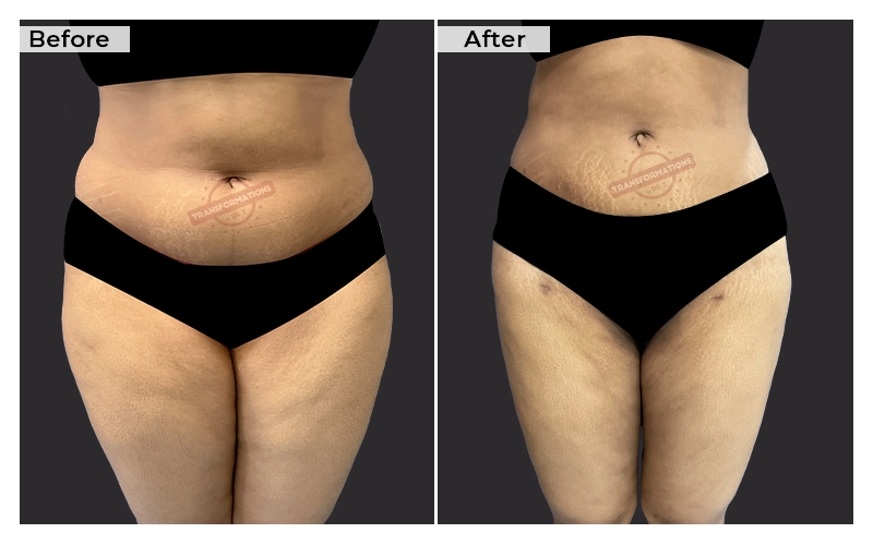 Liposuction