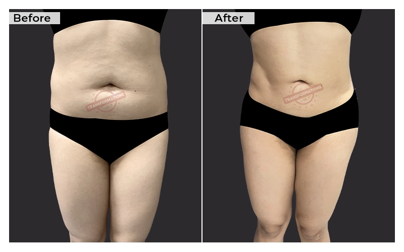 Liposuction