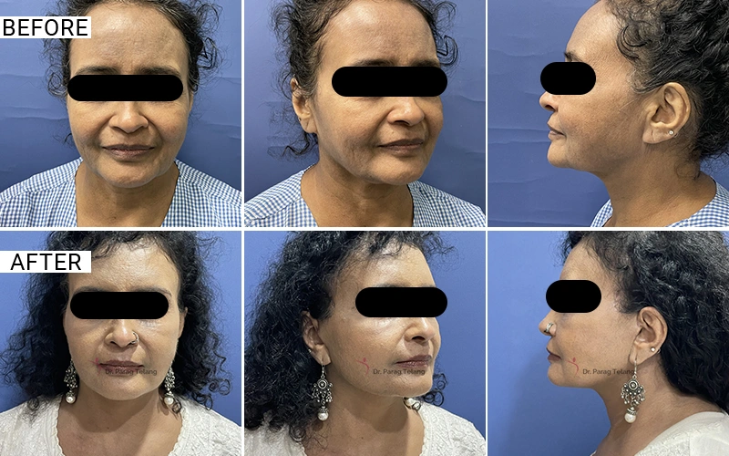 Facelift & Necklift