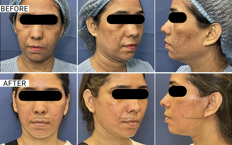 Facelift & Necklift