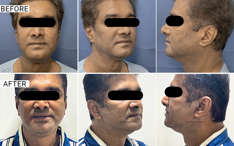 Facelift & Necklift