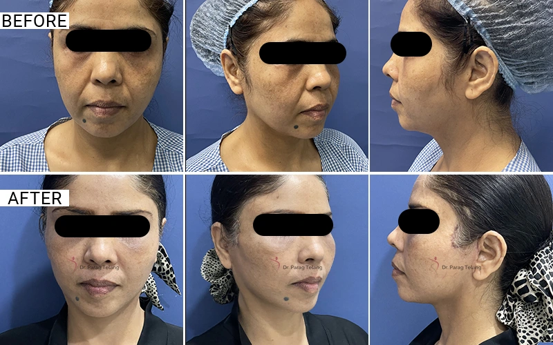 Facelift & Necklift