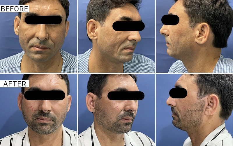 Facelift & Necklift