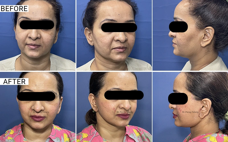 Facelift & Necklift