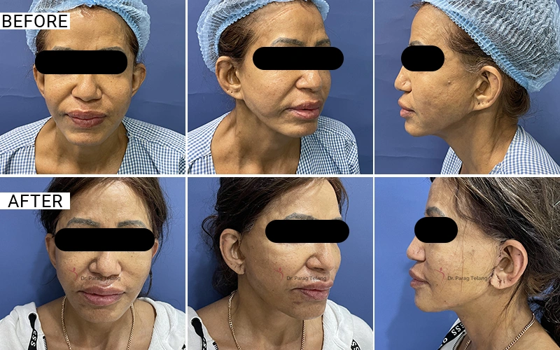 Facelift & Necklift
