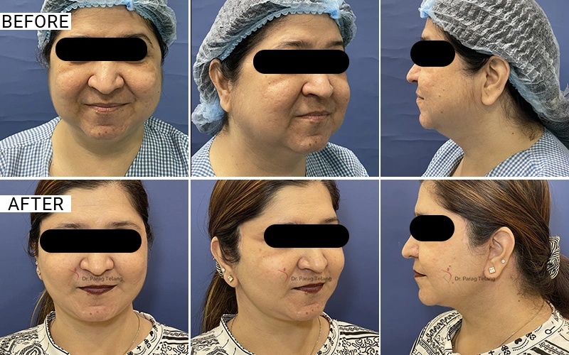 Facelift & Necklift
