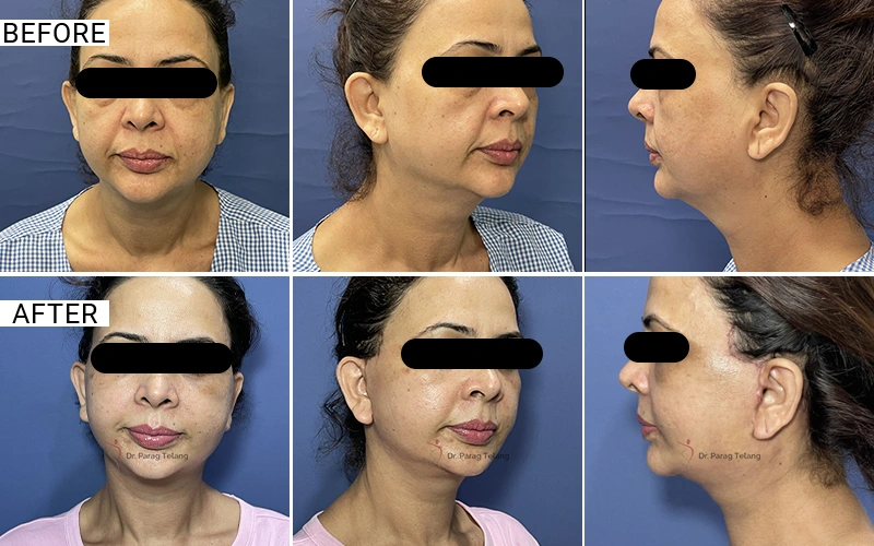 Facelift & Necklift