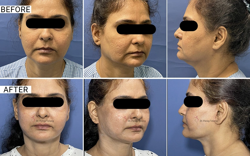 Facelift & Necklift