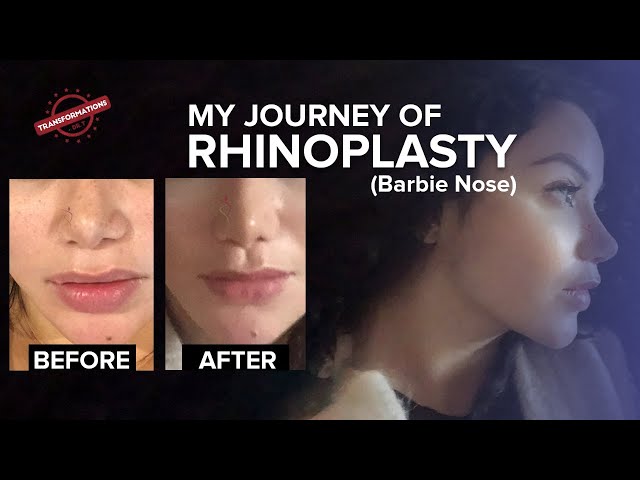 Rhinoplasty