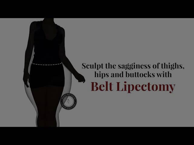 Belt Lipectomy Procedure