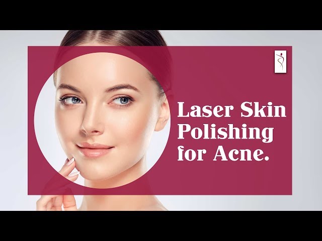 Laser Polishing for Acne Marks