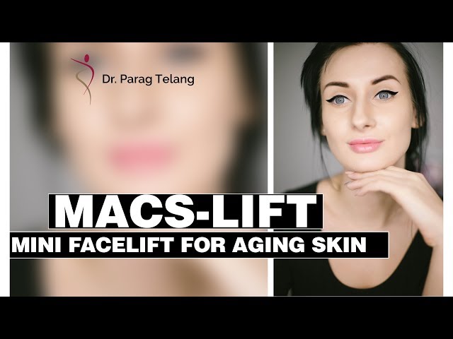 MACS-LIFT